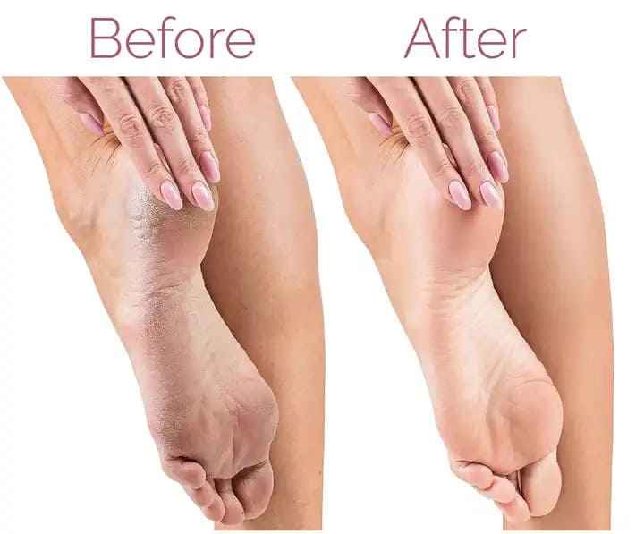 Electric Foot Callus Remover - Luxemir Store