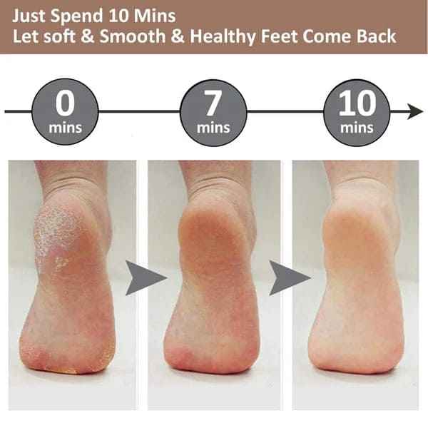 Electric Foot Callus Remover - Luxemir Store
